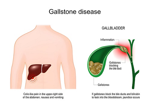 Best Gallbladder Stone Treatment in Andheri